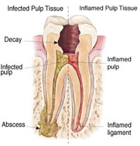 root canal graphic