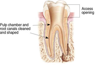 root canal graphic