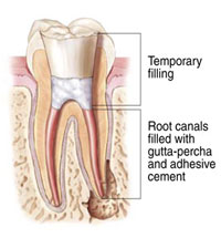 root canal graphic