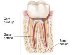 root canal graphic